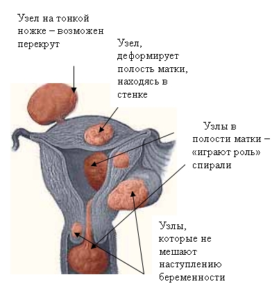 Анемия при миоме матки признаки